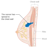 Ayurvedic Treatment for Breast Cancer