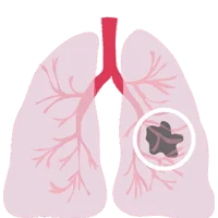 Ayurvedic Treatment for Lung Cancer