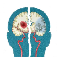 Ayurvedic Treatment for Brain Tumor
